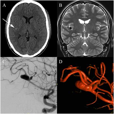 Treatment and Postinterventional Management of a Fusiform Intracranial Aneurysm in a Professional Soccer Player: A Case Report